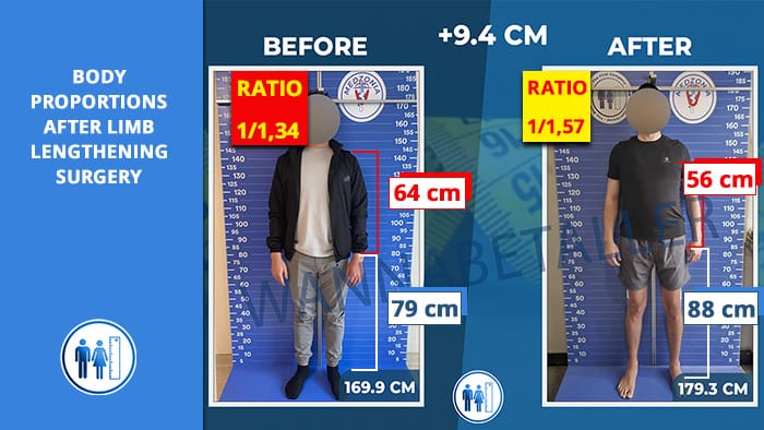 proporciones después de la cirugía de alargamiento de extremidades