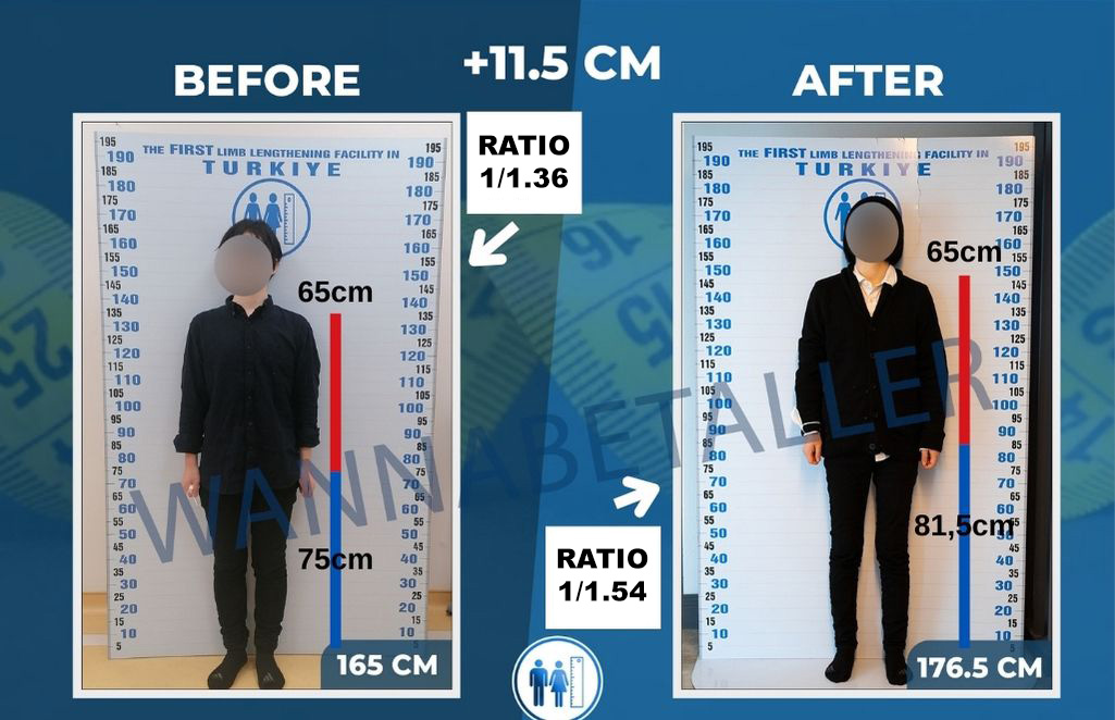 proporciones después de la cirugía de alargamiento de extremidades