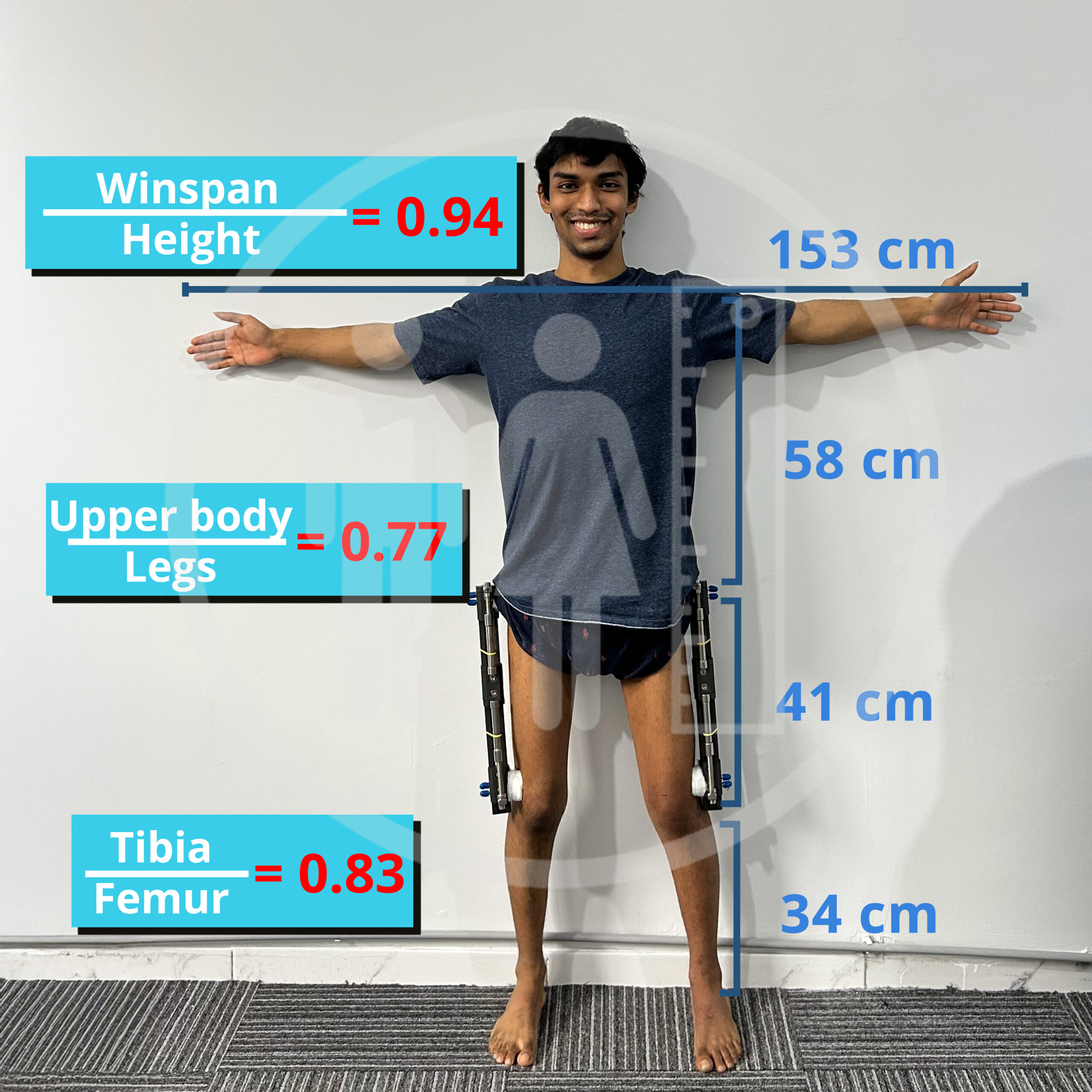 proporciones después de la cirugía de alargamiento de extremidades