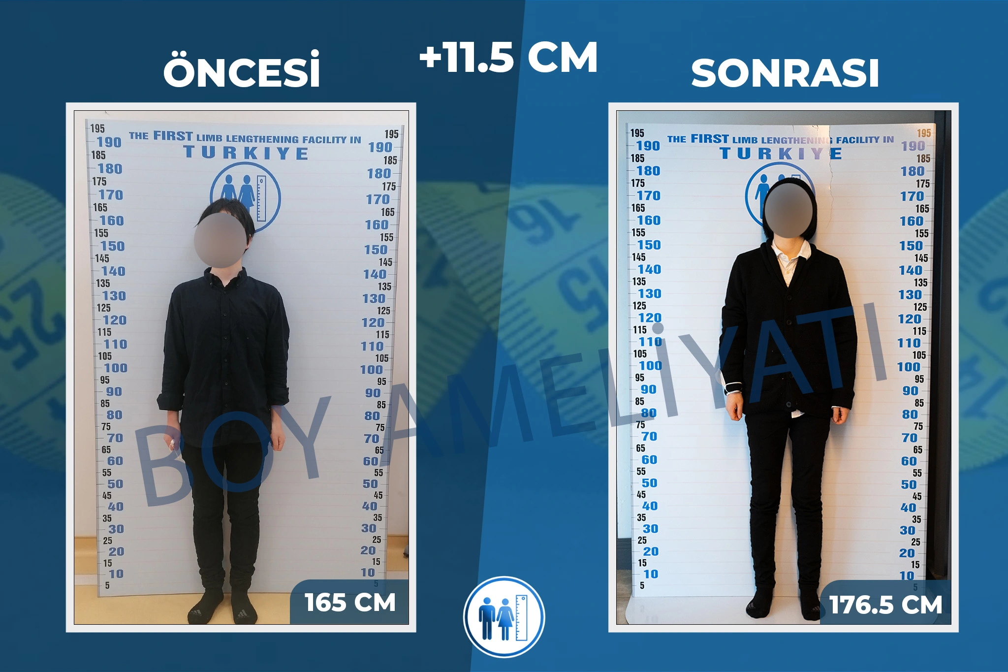 boy-uzatma-ameliyati-14