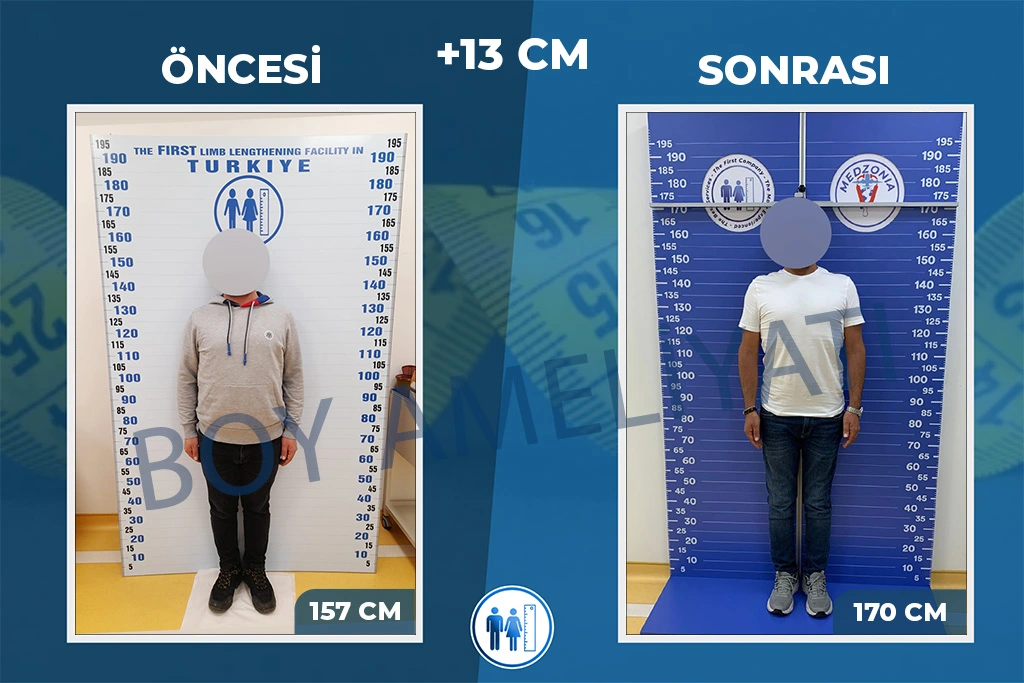 boy-uzatma-ameliyati-18