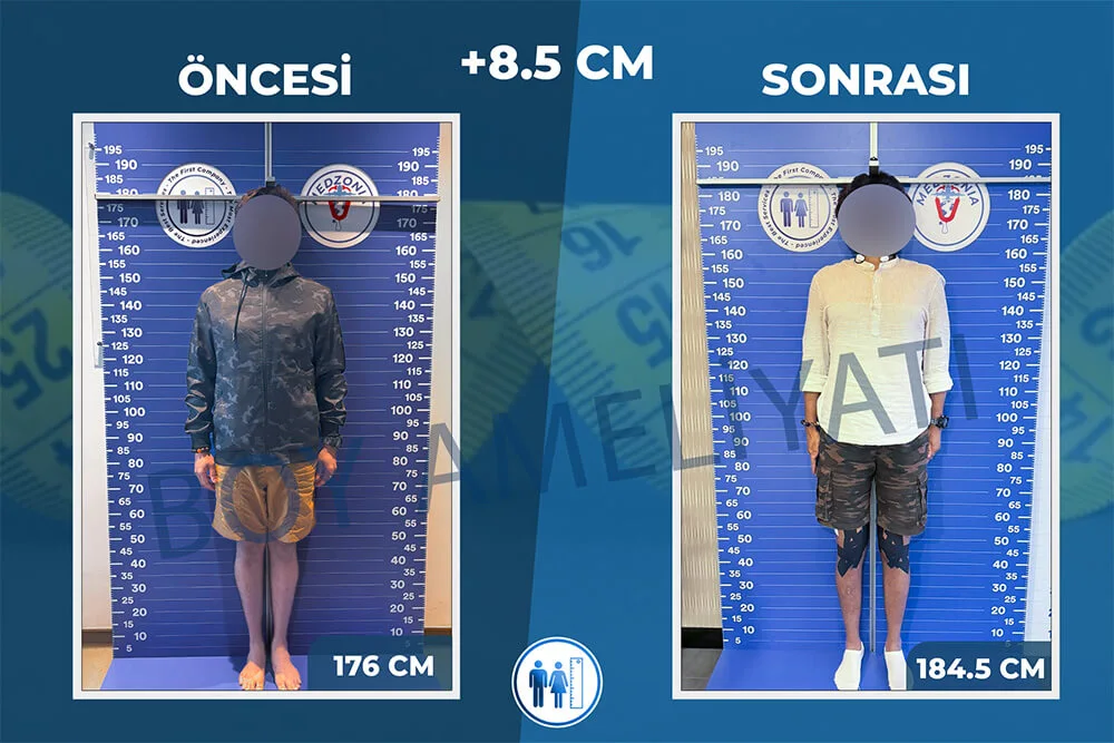 boy-uzatma-ameliyati-21