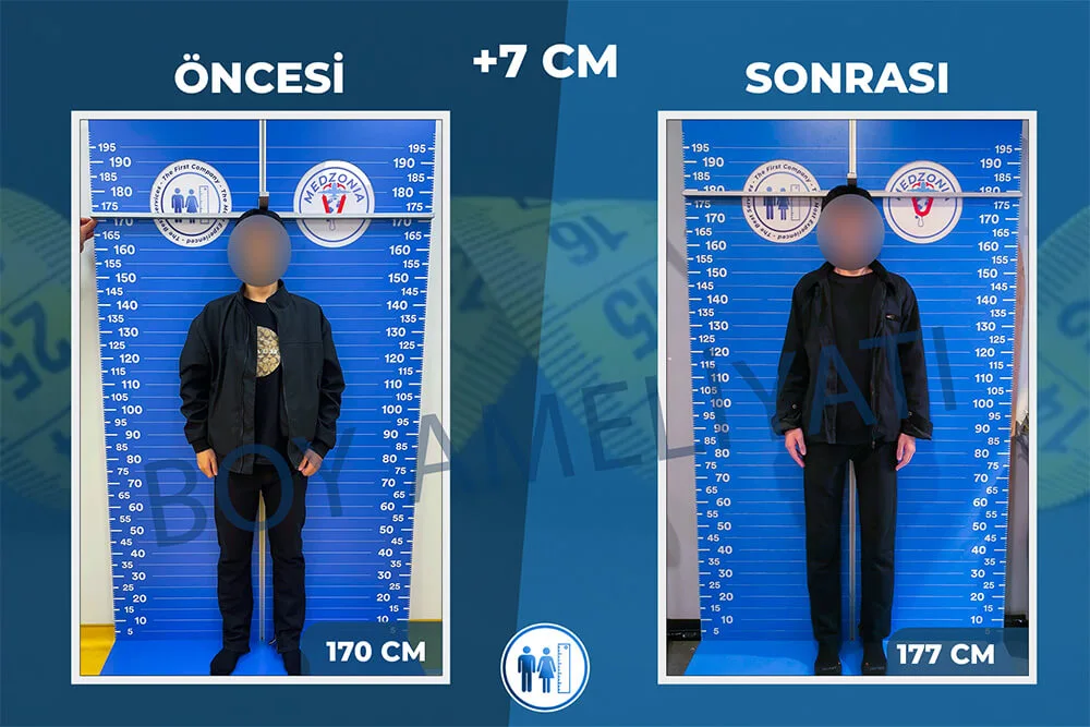 boy-uzatma-ameliyati-24