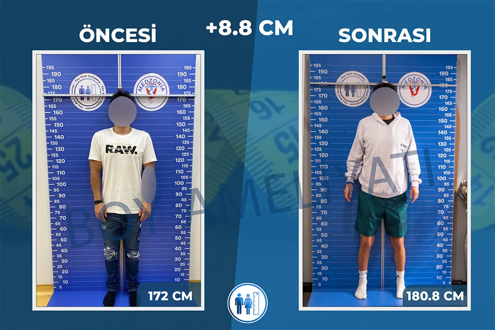 boy-uzatma-ameliyati-27