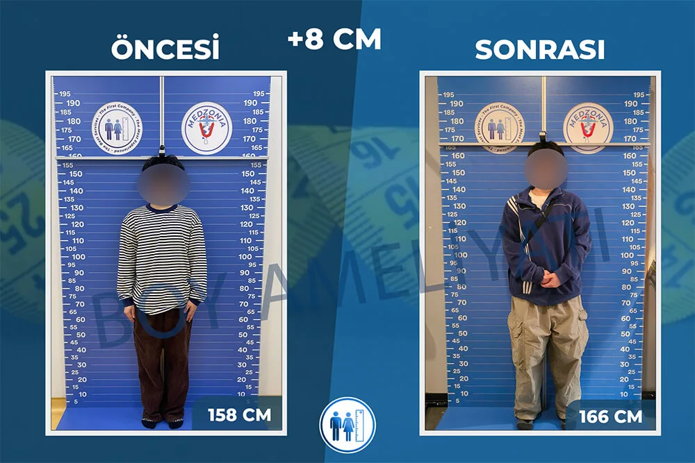 boy-uzatma-ameliyati-28