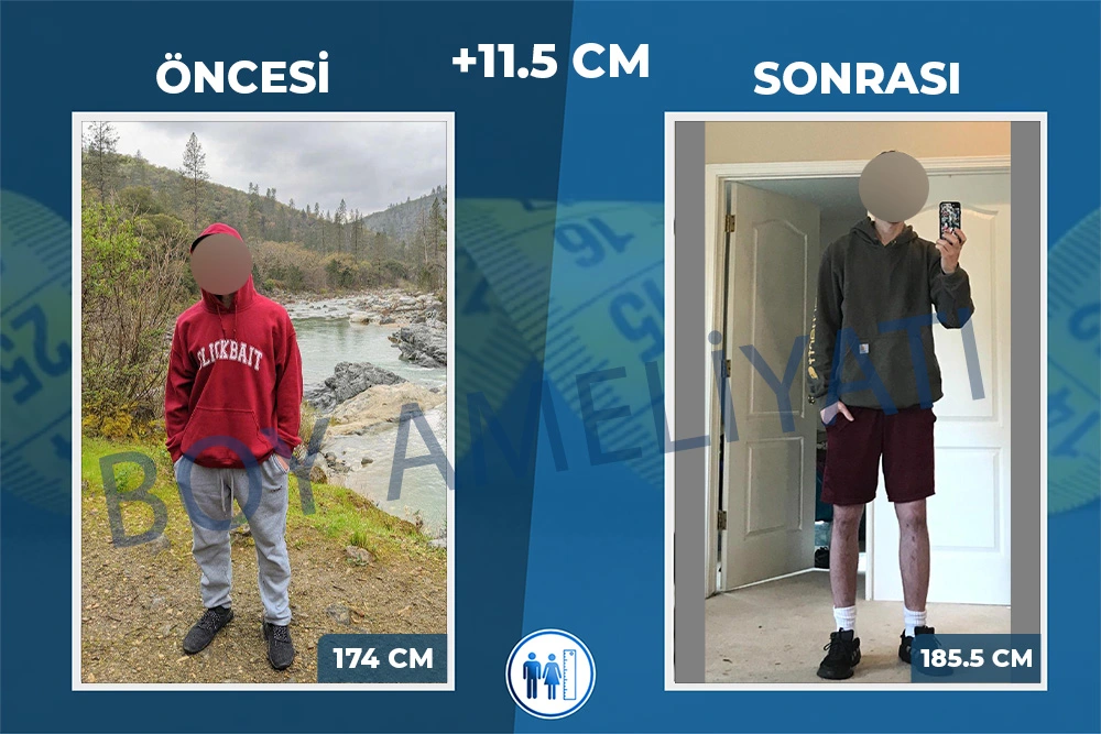 Boy Uzatma Ameliyatı Öncesi Sonrası