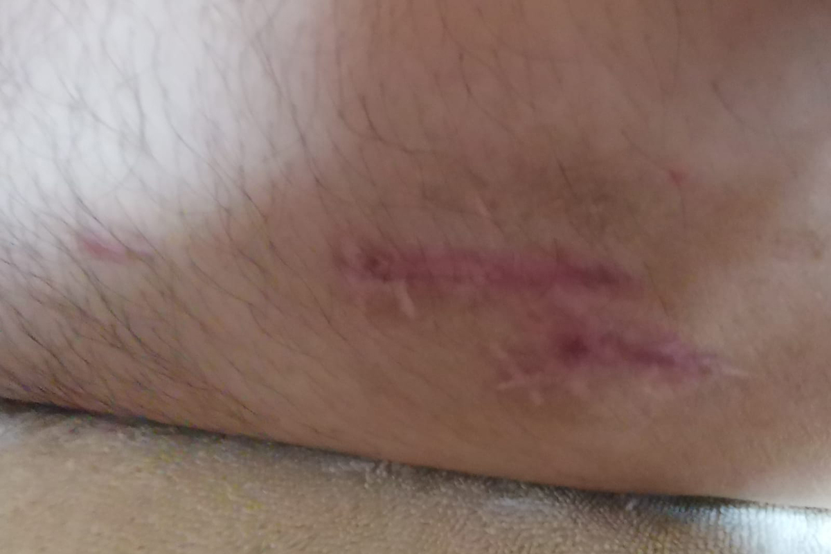 scar 2